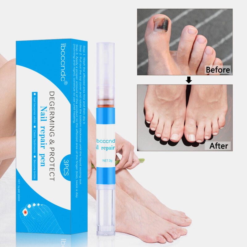 3ml Onychomycosis Repair Solution Leczenie Grzybicy Paznokci Olejek Pen Wzrost Przeciw Infekcji Przyrząd Do Usuwania Skórek Płyn